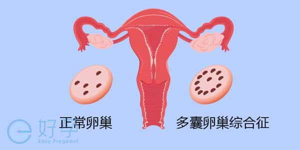 多囊卵巢-俄罗斯做试管婴儿