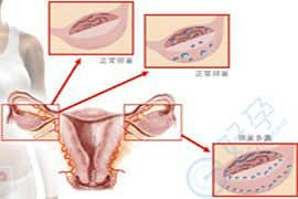 多囊卵巢-泰国第三代试管婴儿-试管婴儿费用