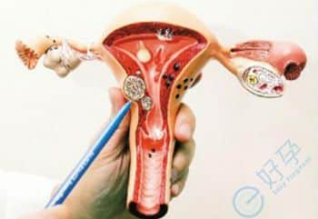 子宫肌瘤切除-试管婴儿成功率-试管婴儿费用