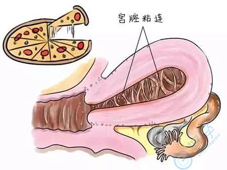 宫腔粘连如何试管婴儿成功，泰国试管费用