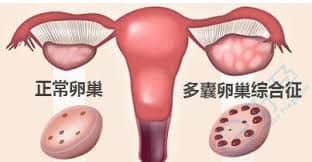 多囊卵巢综合症促排卵成功率，第三代管婴儿费用多少