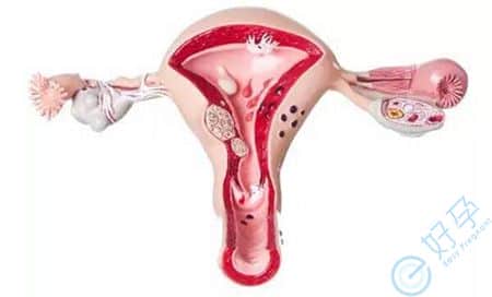 卵巢巧克力囊肿做试管婴儿长方案具体流程