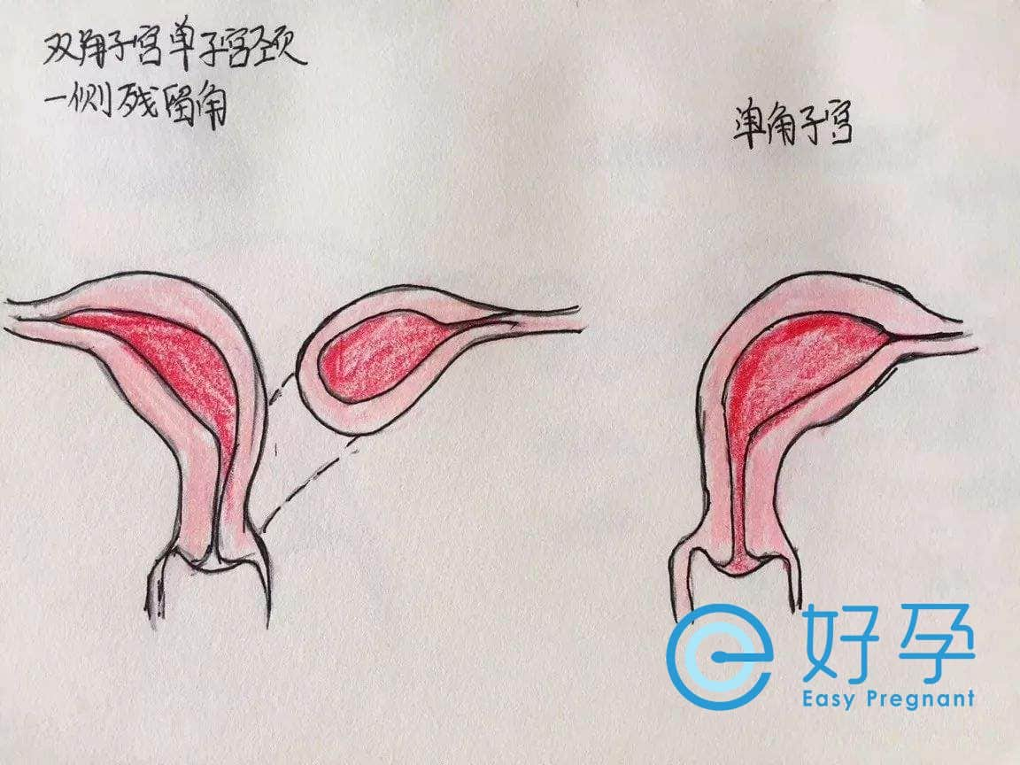 e好孕-单角子宫.jpg