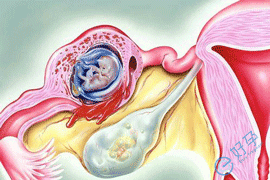 宫外孕做试管婴儿成功率高吗?