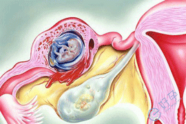 E好孕：有宫外孕史，做试管婴儿可以避免再次宫外孕吗？