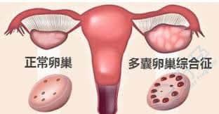 多囊综合症选择试管婴儿助孕，成功率有多高？