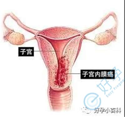 泰国试管婴儿：多次促排会引发子宫内膜癌症吗？