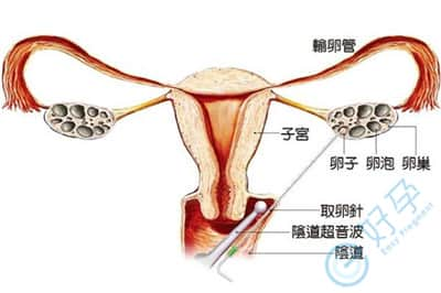 卵泡发育不良不孕率达27%，该如何提高卵子质量