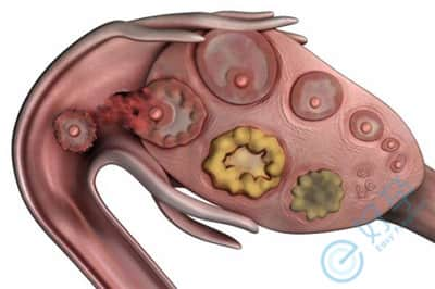 分析卵泡发育不良的5个因素 3步提升泰国试管婴儿成功率