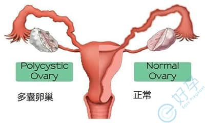 多囊卵巢综合征做泰国试管婴儿，成功率有多高？