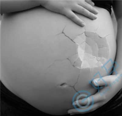 容易导致胎停的主要原因有哪些？