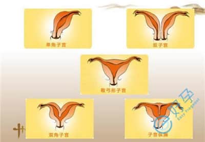 子宫畸形会因为哪些原因而不孕？做试管需要哪些条件？