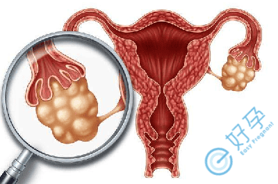 女性卵巢囊肿如何实现好孕？