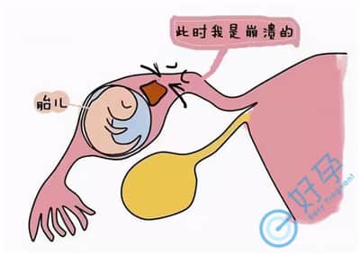 试管婴儿移植后监测HCG可以排除宫外孕吗？