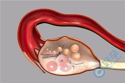 排卵障碍意味着卵巢早衰吗？哪些人群更容易卵巢早衰？
