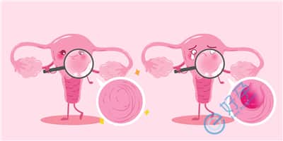 子宫内膜息肉如何产生?对做试管婴儿有影响吗?