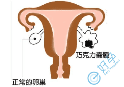 患有巧克力囊肿，去泰国做试管如何提高妊娠率?