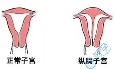 纵膈子宫做试管可以吗？具体方案是什么？