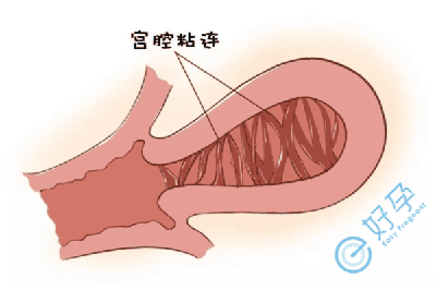 宫腔粘连导致不孕的原因有哪些？试管前该如何处理？