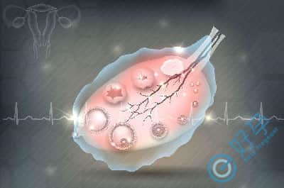 子宫内膜异位症在试管中有什么好的诱导排卵方案