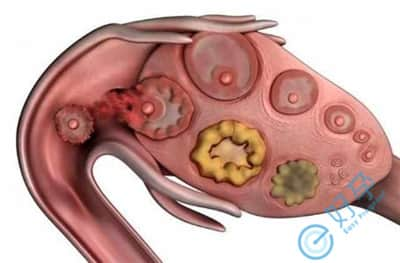 未破裂卵泡黄素化综合征你了解多少?怀孕的几率还大吗
