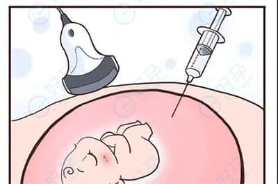 羊水穿刺r.jpg