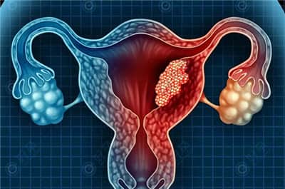 子宫内膜炎会影响试管婴儿成功率吗？