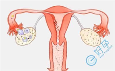 卵巢排卵障碍，子宫内膜薄，也许都跟多囊卵巢有关