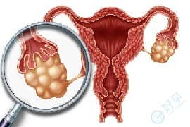 卵巢囊肿的女性做试管，会遇到哪些问题?如何解决?