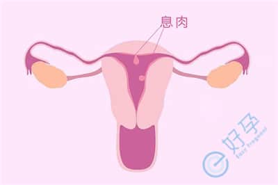 试管前检查出子宫内膜息肉，影响大吗?需要如何处理?