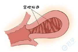 有严重的宫腔粘连，能去泰国做试管婴儿吗？