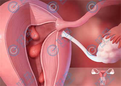 子宫息肉的3种危害，如何决定能不能做试管？