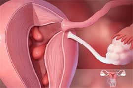 子宫内膜息肉切除后，做试管婴儿的成功率高吗？