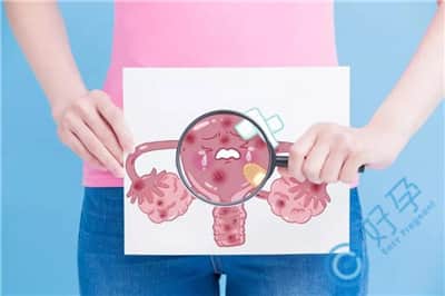 有多囊卵巢综合征，去泰国做试管婴儿前如何调理？