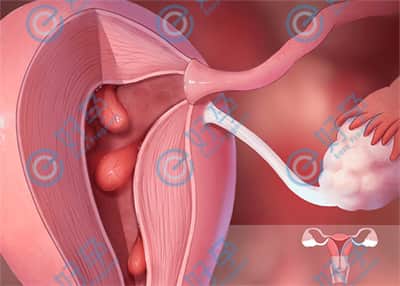 子宫内膜厚是什么原因引起的，试管前如何提高着床率？