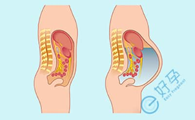 试管取卵后是否会腹水，看完这篇您应该清楚了