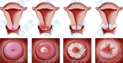 宫颈性不孕的原因有哪些？影响做试管婴儿吗？