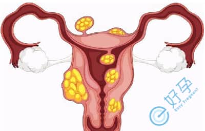 探究子宫肌瘤对泰国试管的影响，如何提高成功率?