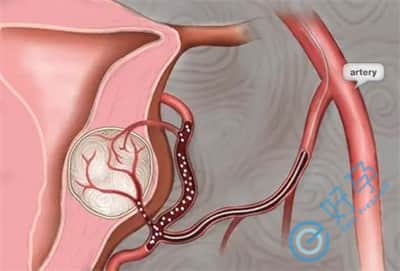 内膜异位症会导致流产甚至不孕？可以做试管婴儿吗？