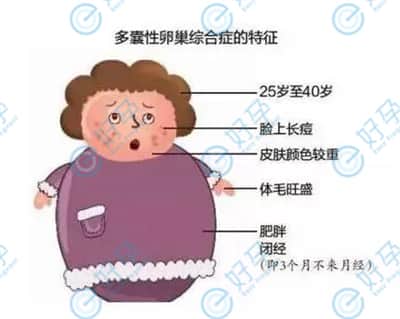 多囊卵巢综合症有哪些症状？做试管婴儿的成功率高吗？