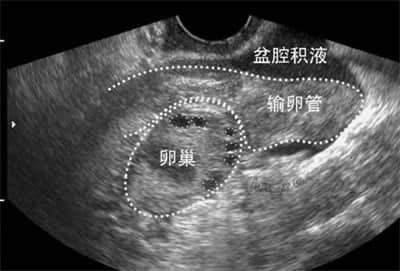 子宫积液做试管婴儿，需要先进行诊治吗？
