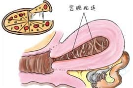 宫腔粘连会导致胎停吗，做试管婴儿是否会有影响？