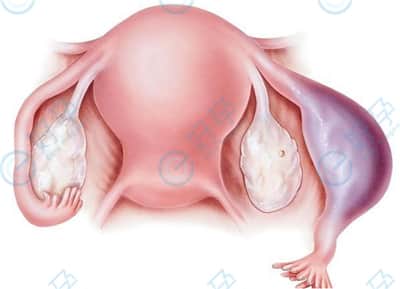 分析输卵管囊肿对试管的影响-试管婴儿的两种助孕方案