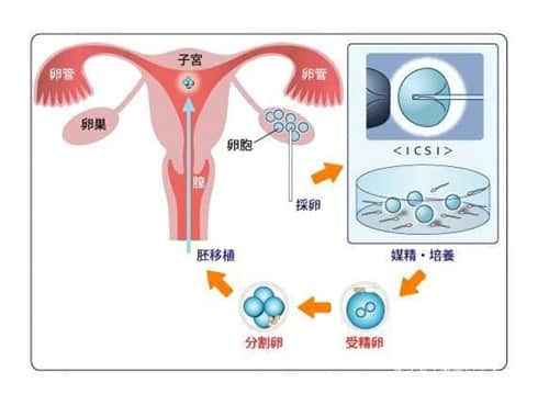 不明原因性不孕症，试管婴儿技术是否成为最后的希望之光？