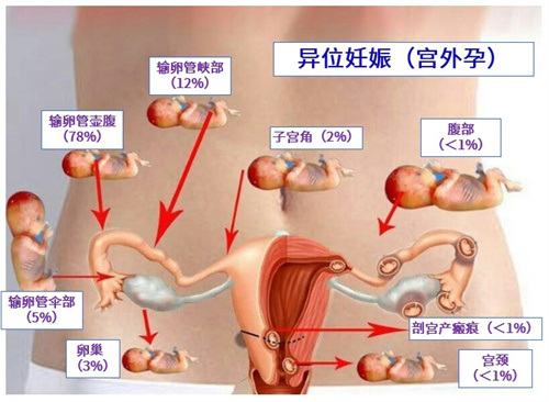 孕妈的噩梦“宫外孕”，做试管婴儿能成功避免吗？