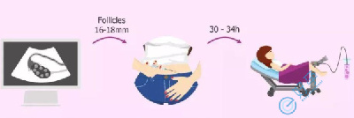 40岁以上做试管婴儿，能取到多少卵子？