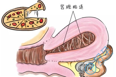 重度宫腔粘连做试管婴儿选用哪种方案？重度宫腔粘连做试管婴儿成功率高吗？