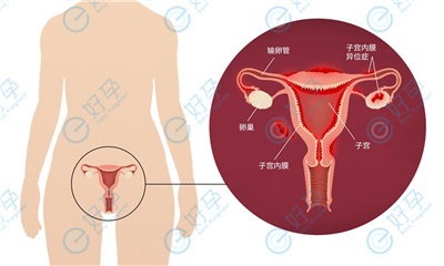 试管婴儿移植时遇到子宫内膜异位怎么办？