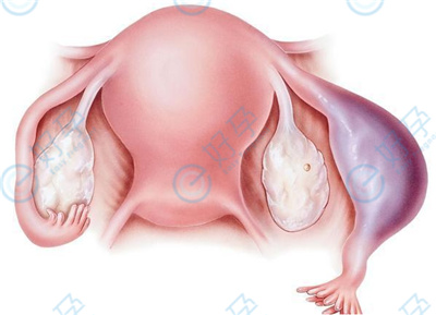 输卵管囊肿与试管婴儿胚胎移植：影响与应对方案