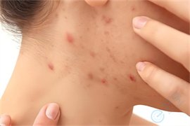 痤疮与多囊卵巢综合征有关吗？能做试管婴儿吗？